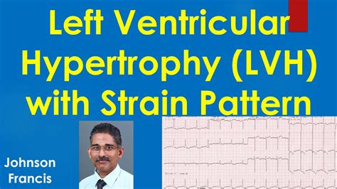 lvh with strain pattern|lvh with strain pattern meaning.